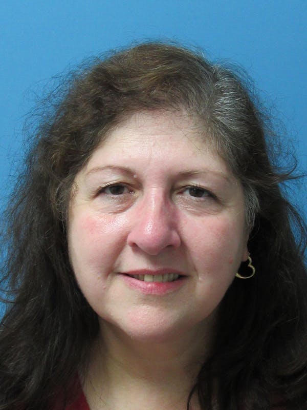 hair restoration patient