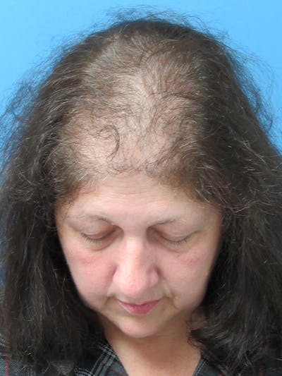 LP Hair Transplant Before & After Gallery - Patient 238653 - Image 1