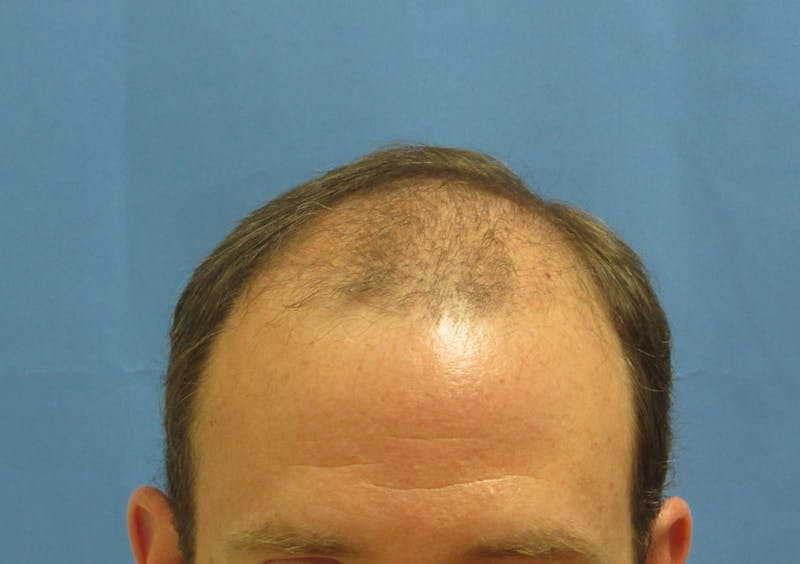 Male Hair Transplant Before & After Gallery - Patient 138474 - Image 1