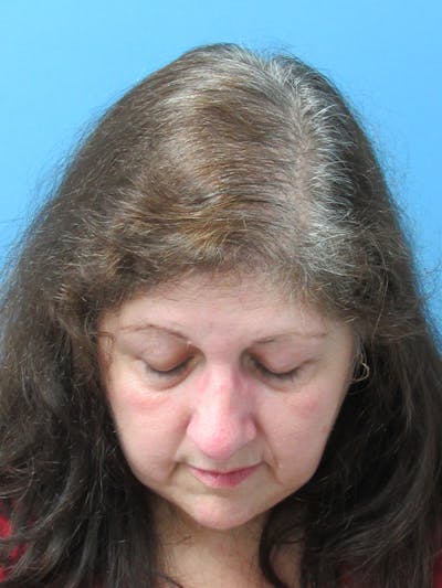 LP Hair Transplant Before & After Gallery - Patient 238653 - Image 2