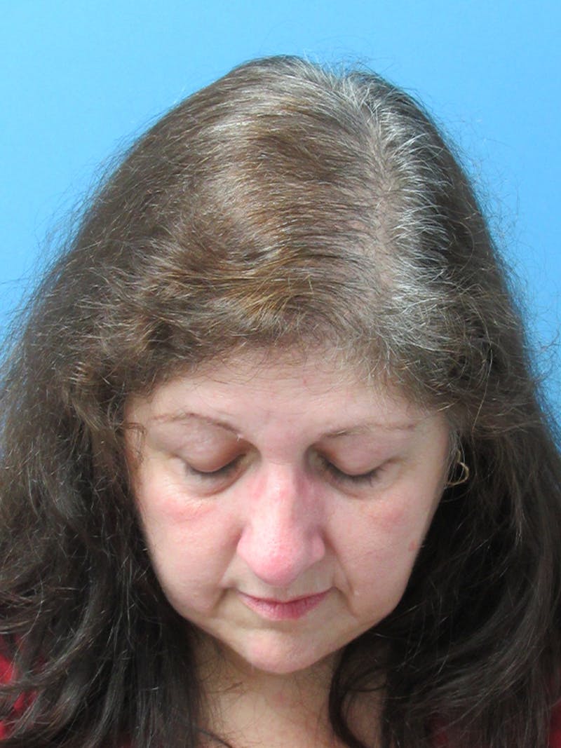 LP Hair Transplant Before & After Gallery - Patient 238653 - Image 2