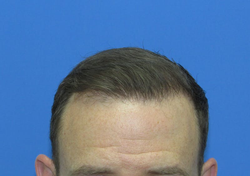 Male Hair Transplant Before & After Gallery - Patient 138474 - Image 2