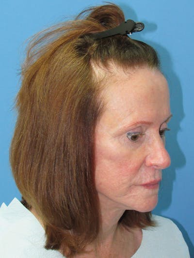 Female Hair Transplant Before & After Gallery - Patient 250221 - Image 1