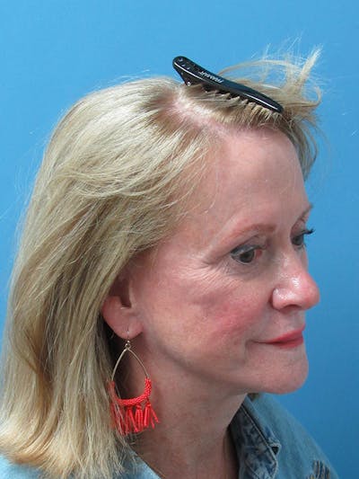 Female Hair Transplant Before & After Gallery - Patient 250221 - Image 2