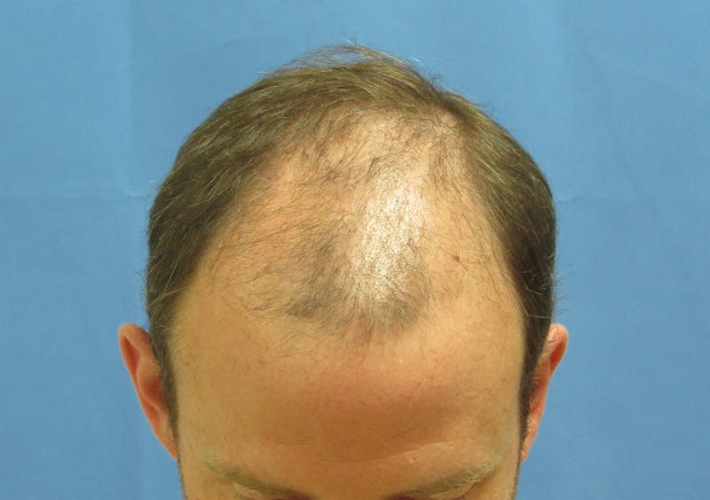 Male Hair Transplant Before & After Gallery - Patient 138474 - Image 3