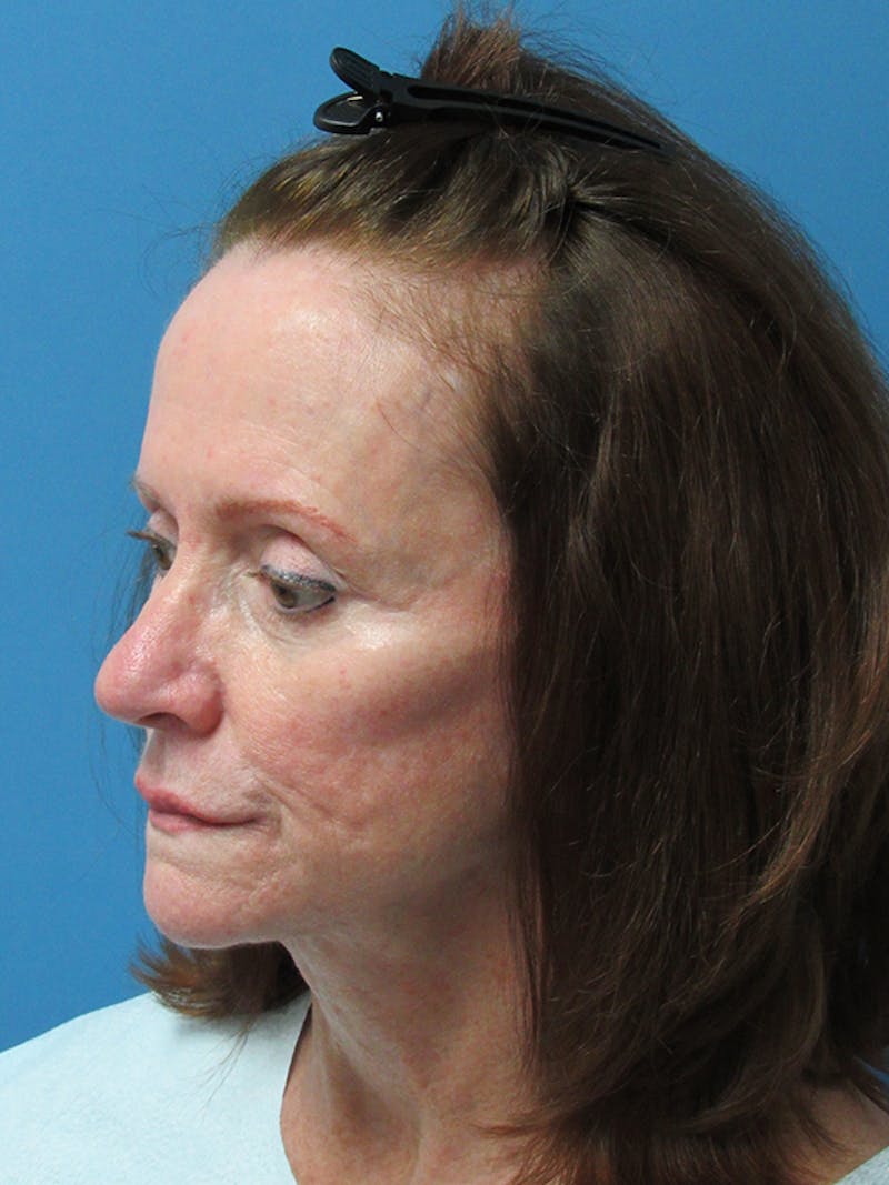 Female Hair Transplant Before & After Gallery - Patient 250221 - Image 3