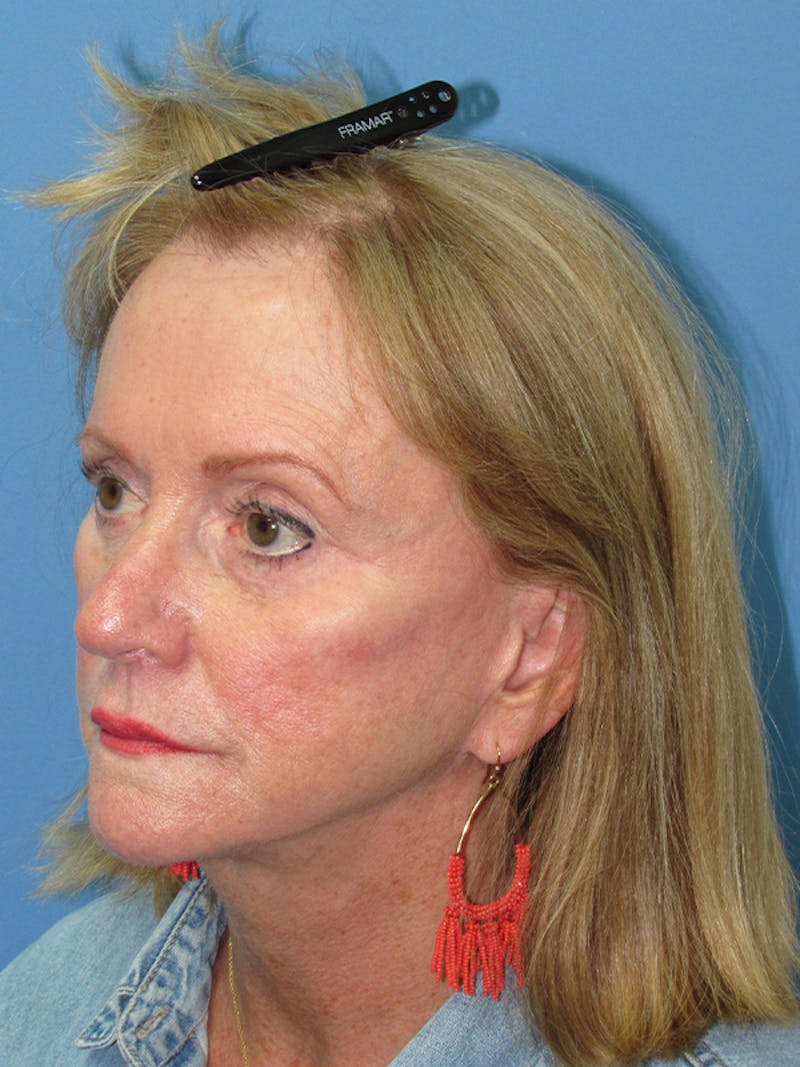 Female Hair Transplant Before & After Gallery - Patient 250221 - Image 4