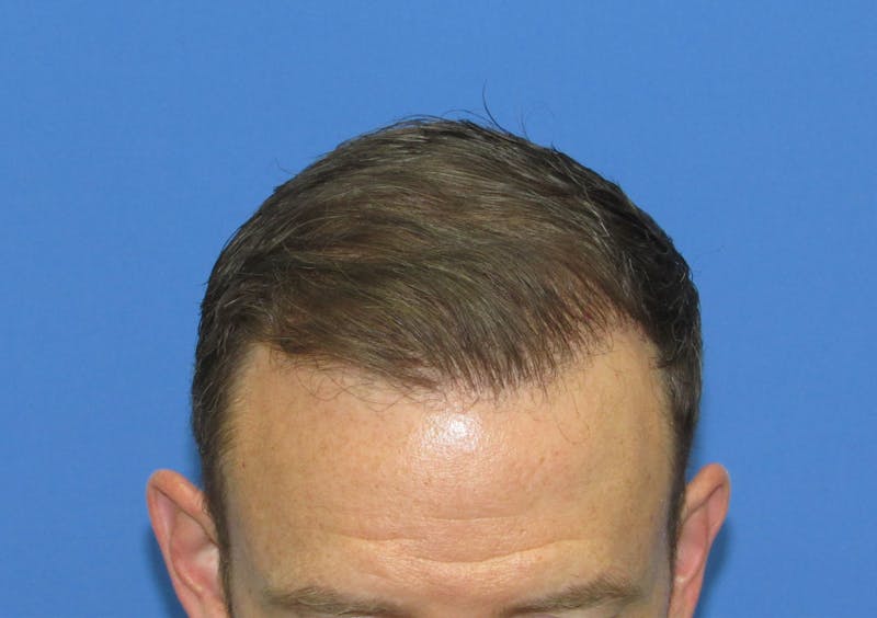 Male Hair Transplant Before & After Gallery - Patient 138474 - Image 4