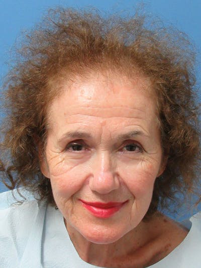 Female Hair Transplant Before & After Gallery - Patient 329908 - Image 1