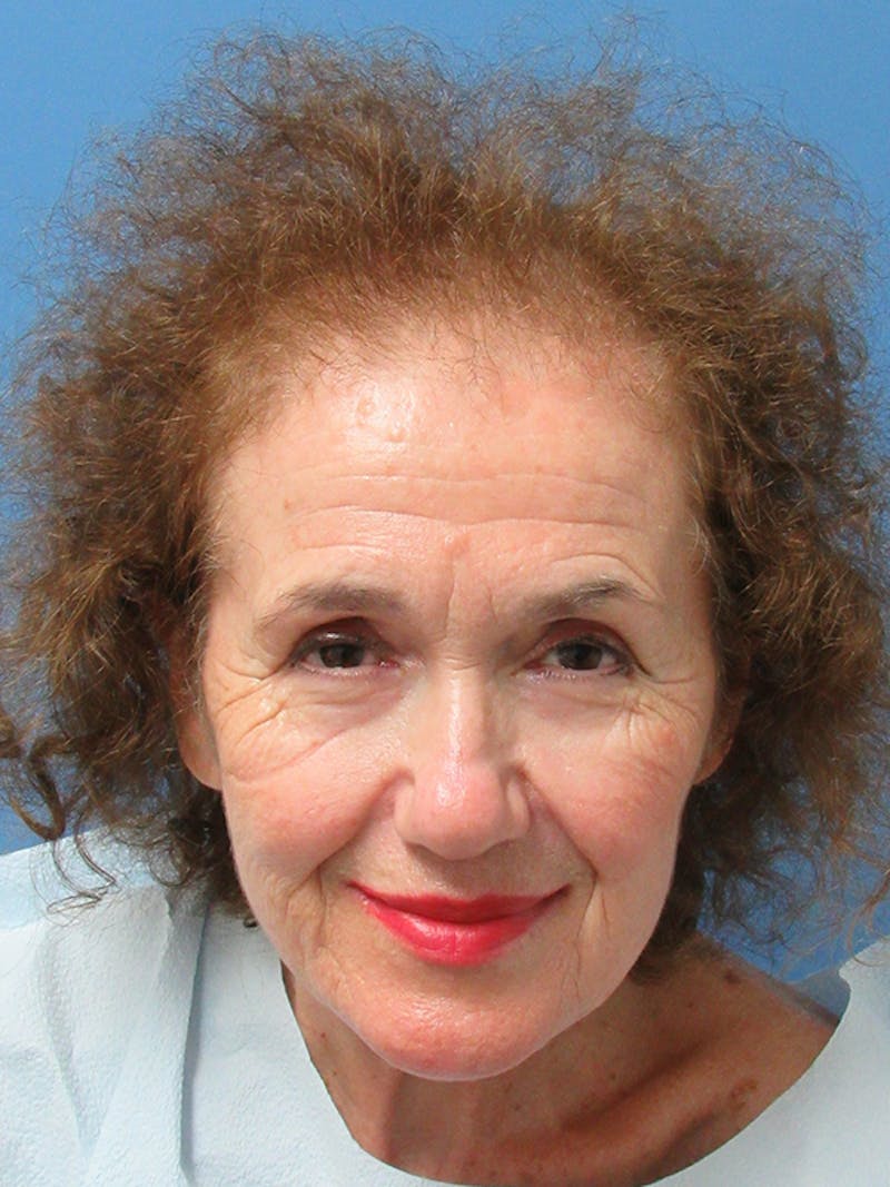 Female Hair Transplant Before & After Gallery - Patient 329908 - Image 1