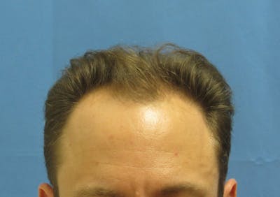 Male Hair Transplant Before & After Gallery - Patient 286355 - Image 1