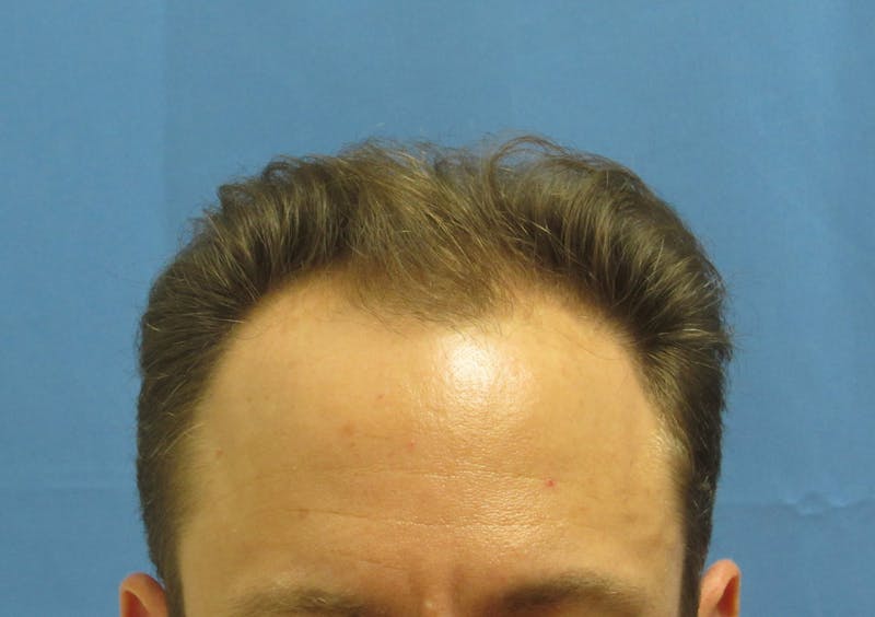 Male Hair Transplant Before & After Gallery - Patient 286355 - Image 1