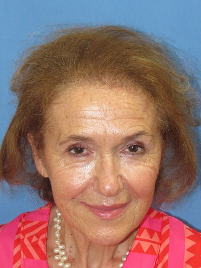 Female Hair Transplant Before & After Gallery - Patient 329908 - Image 2