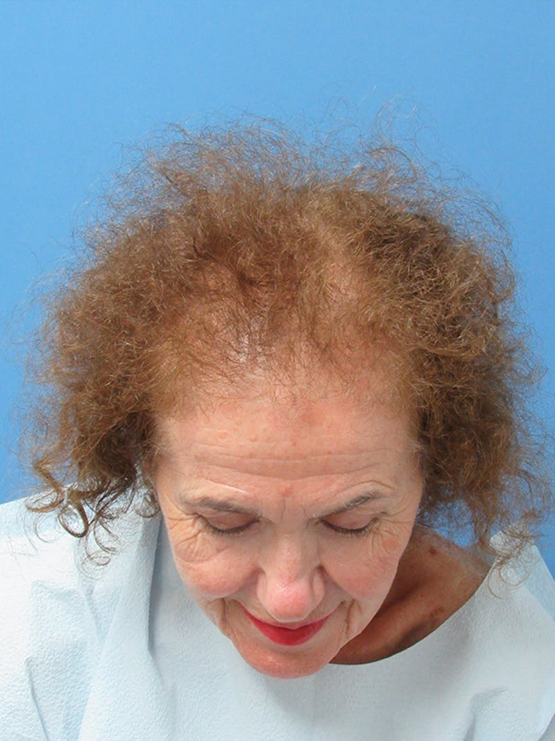 Female Hair Transplant Before & After Gallery - Patient 329908 - Image 3