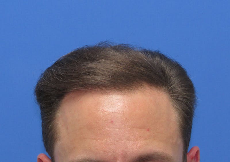 Male Hair Transplant Before & After Gallery - Patient 286355 - Image 2