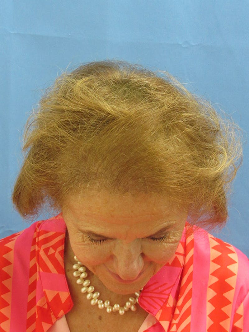 Female Hair Transplant Before & After Gallery - Patient 329908 - Image 4