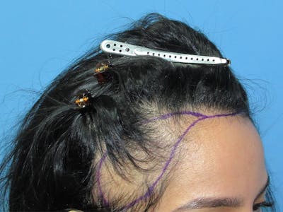 Female Hair Transplant Before & After Gallery - Patient 195541 - Image 1
