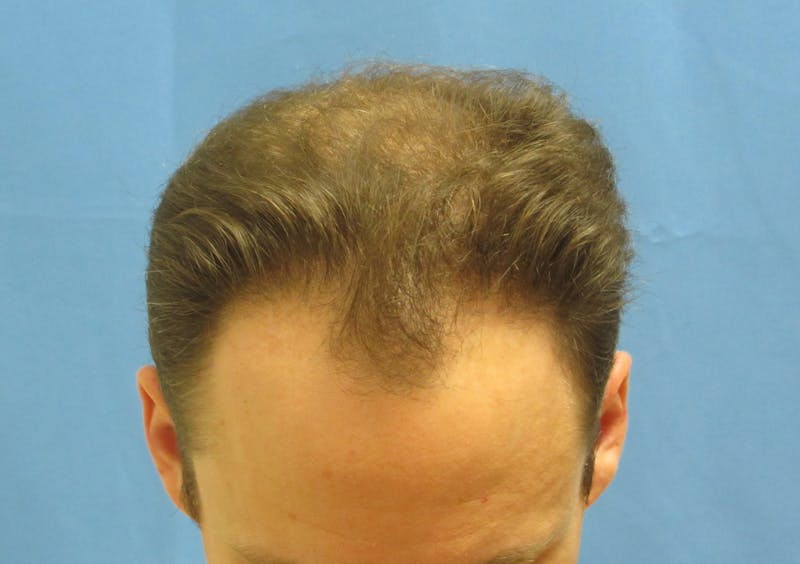 Male Hair Transplant Before & After Gallery - Patient 286355 - Image 3