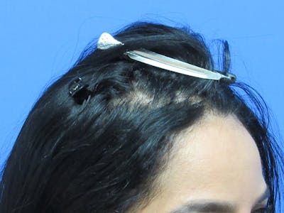 Female Hair Transplant Before & After Gallery - Patient 195541 - Image 2