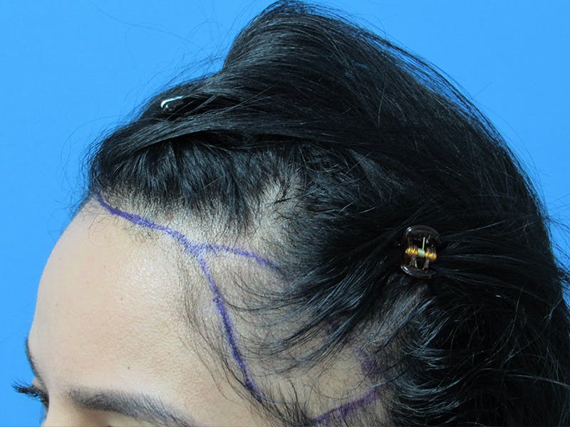 Female Hair Transplant Before & After Gallery - Patient 195541 - Image 3