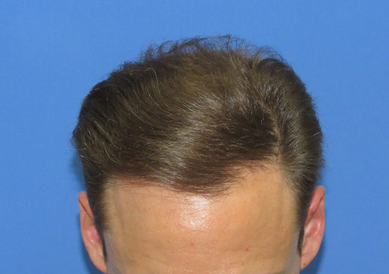 Male Hair Transplant Before & After Gallery - Patient 286355 - Image 4