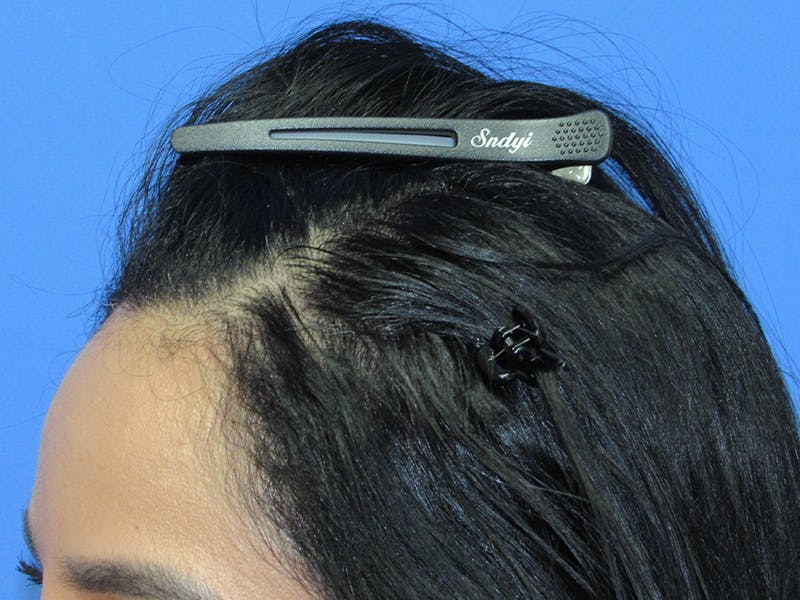 Female Hair Transplant Before & After Gallery - Patient 195541 - Image 4