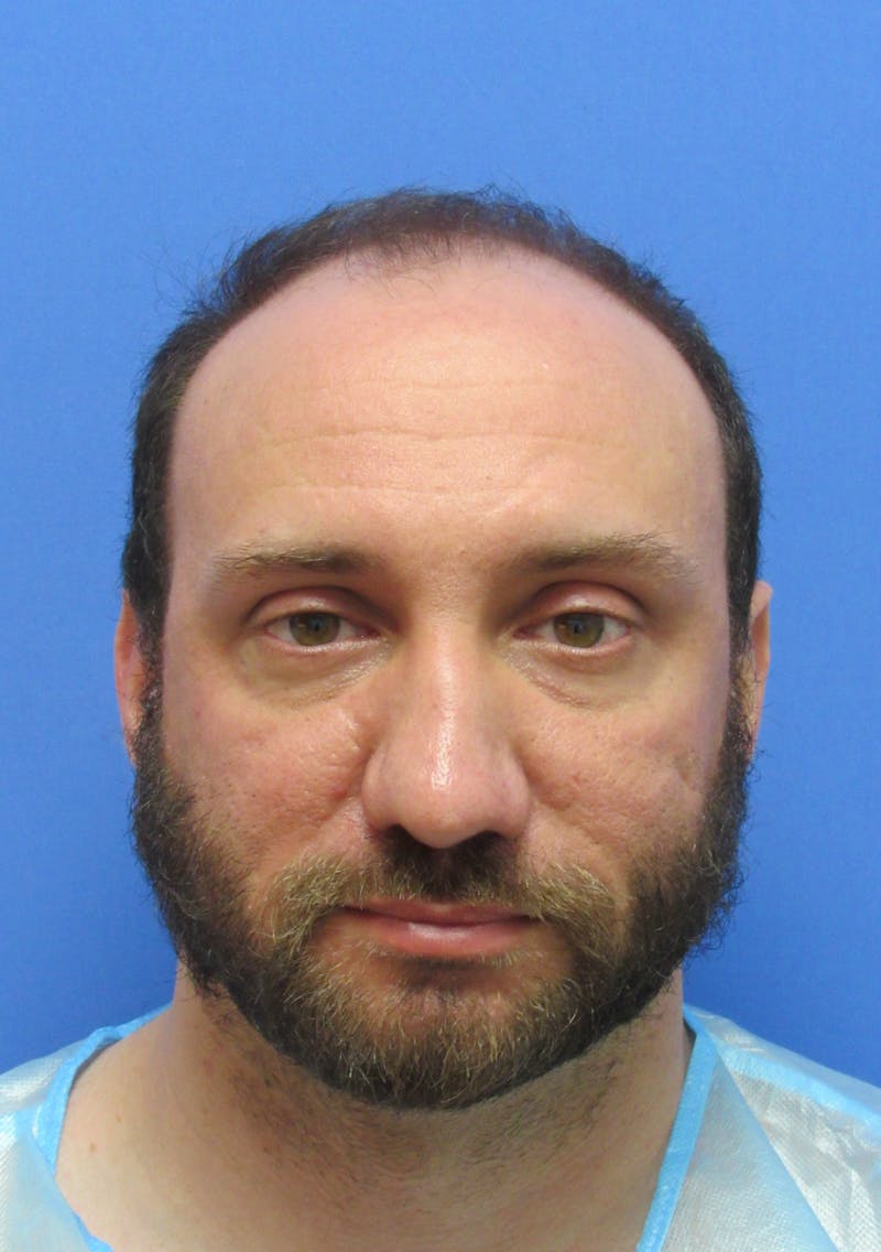 Male Hair Transplant Before & After Gallery - Patient 141056 - Image 1