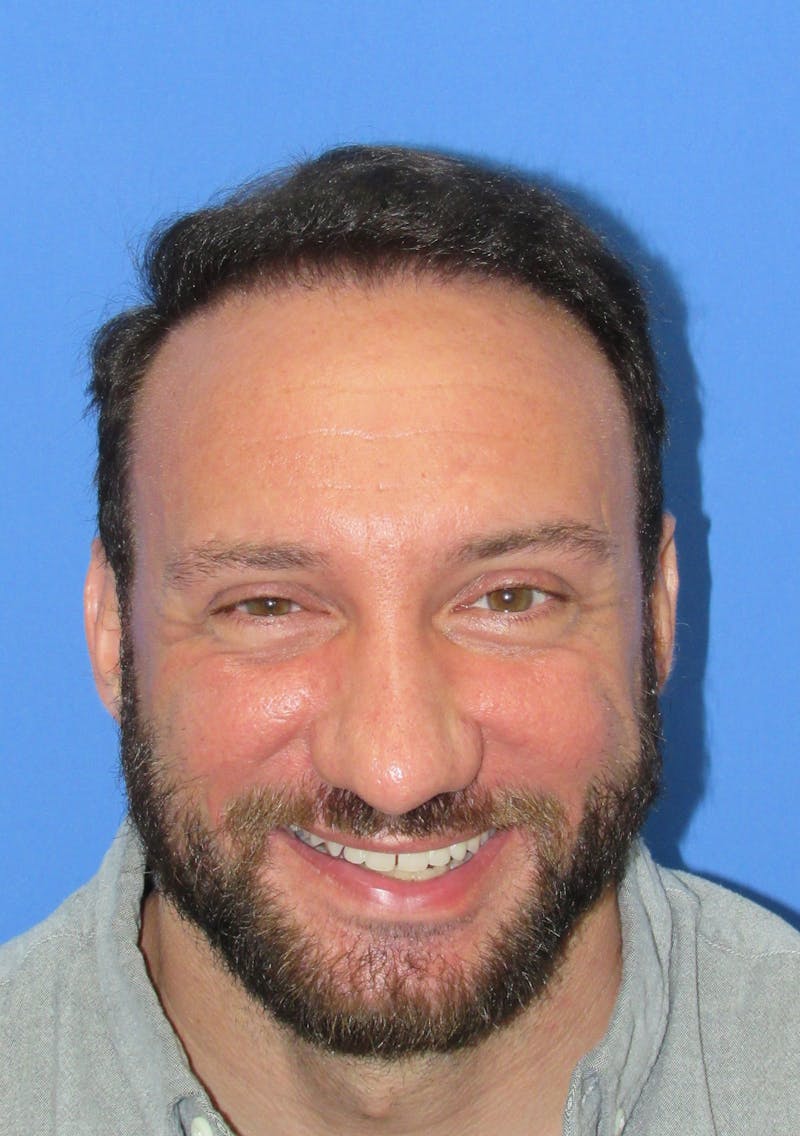 Male Hair Transplant Before & After Gallery - Patient 141056 - Image 2