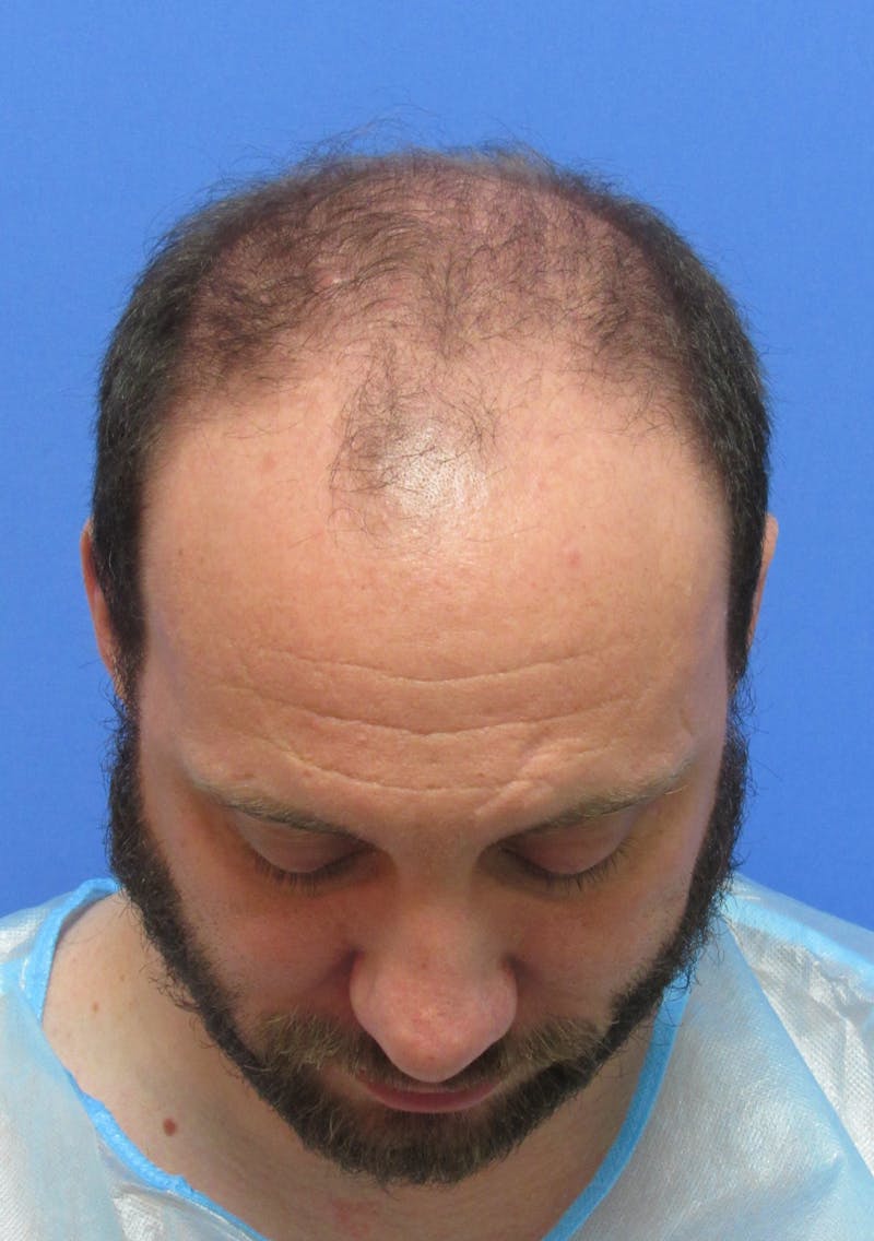 Male Hair Transplant Before & After Gallery - Patient 141056 - Image 3