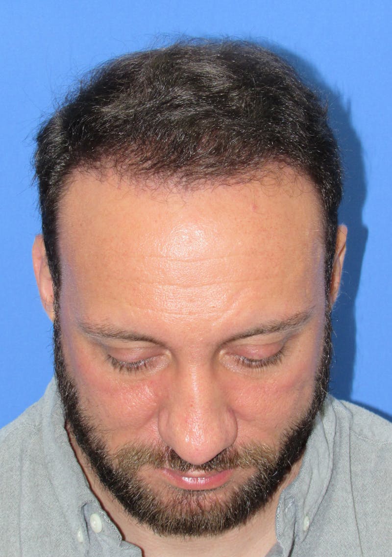 Male Hair Transplant Before & After Gallery - Patient 141056 - Image 4