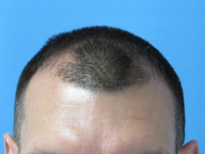 Male Hair Transplant Before & After Gallery - Patient 389365 - Image 1