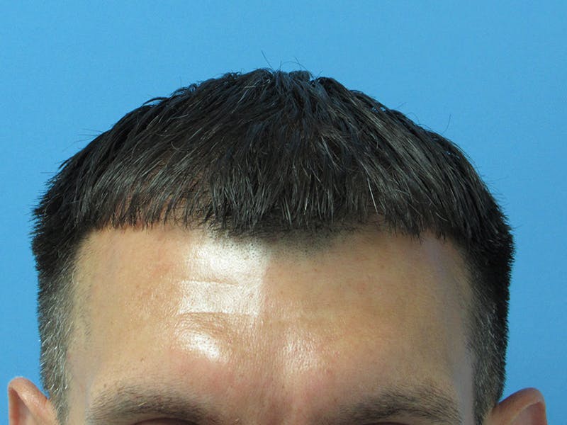 Male Hair Transplant Before & After Gallery - Patient 389365 - Image 2