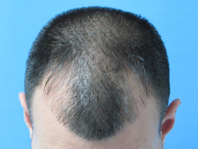 Male Hair Transplant Before & After Gallery - Patient 389365 - Image 3