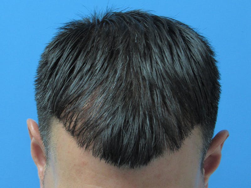 Male Hair Transplant Before & After Gallery - Patient 389365 - Image 4
