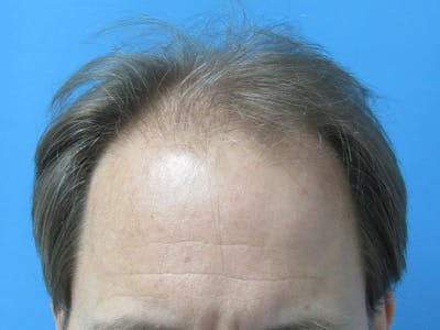 Male Hair Transplant Before & After Gallery - Patient 218420 - Image 1