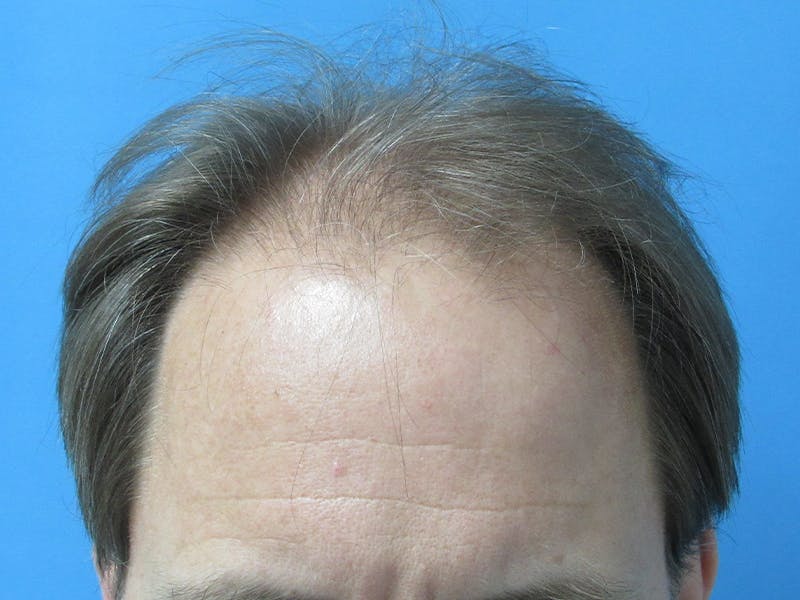 Male Hair Transplant Before & After Gallery - Patient 218420 - Image 1