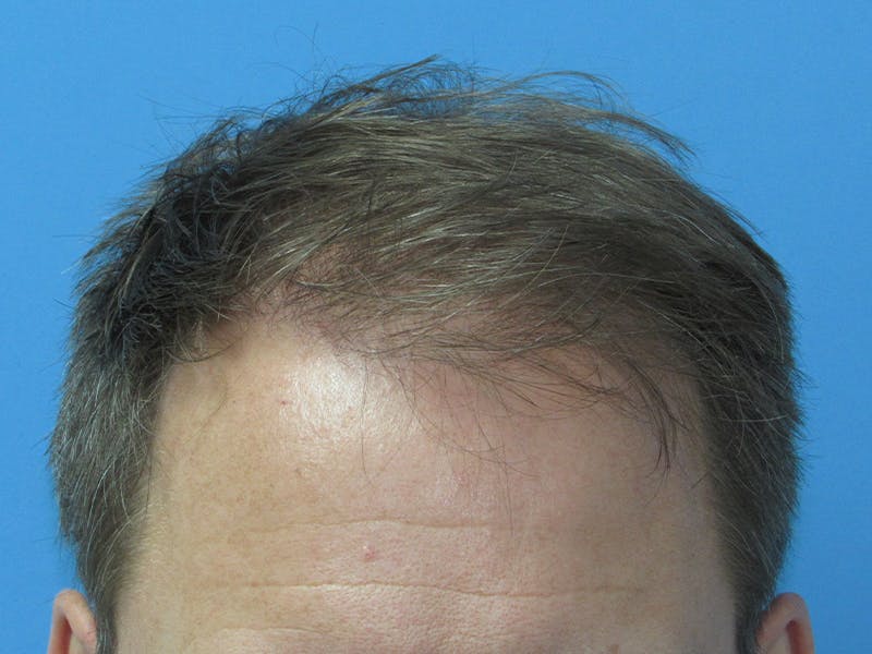 Male Hair Transplant Before & After Gallery - Patient 218420 - Image 2