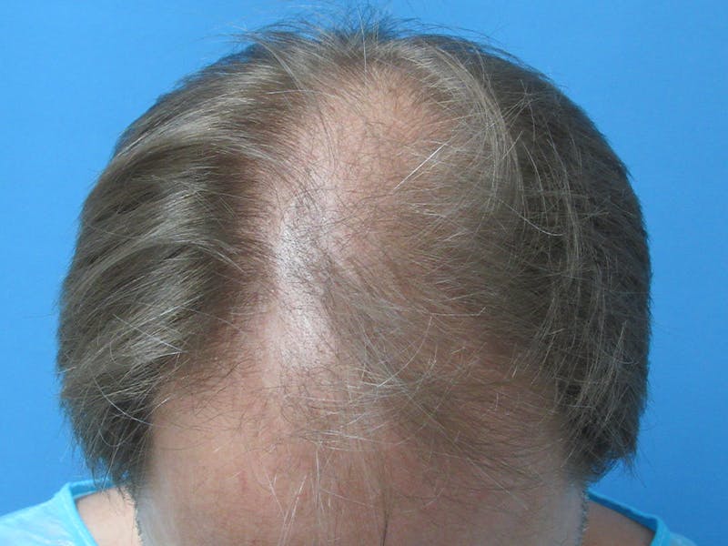 Male Hair Transplant Before & After Gallery - Patient 218420 - Image 3