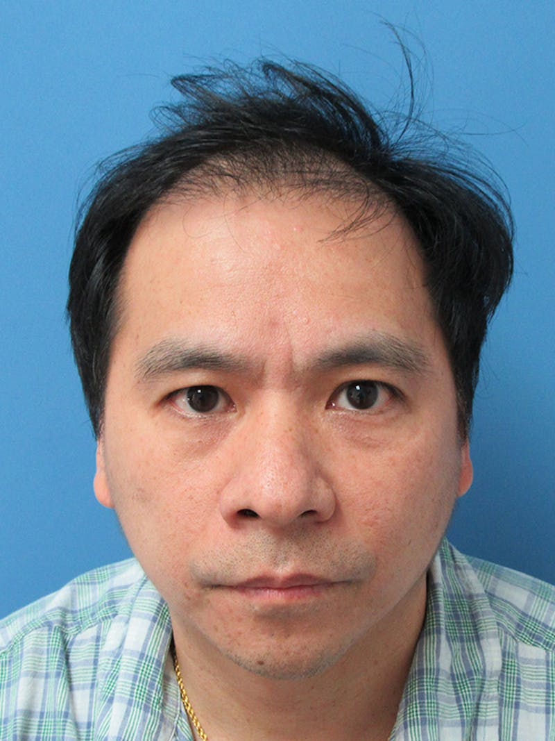 Male Hair Transplant Before & After Gallery - Patient 232158 - Image 1
