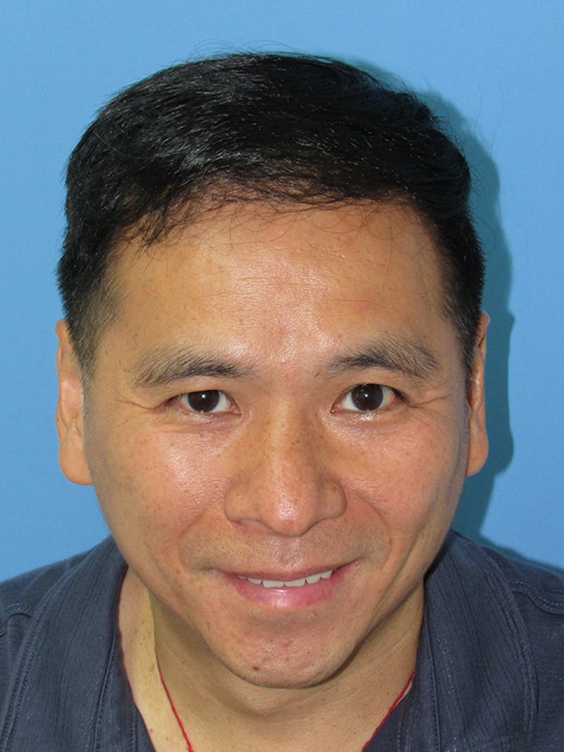 Male Hair Transplant Before & After Gallery - Patient 232158 - Image 2