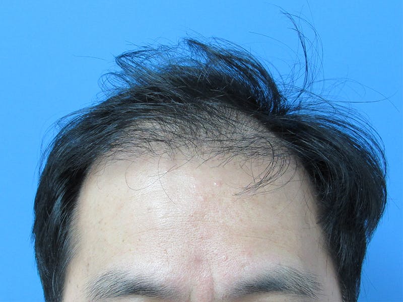 Male Hair Transplant Before & After Gallery - Patient 232158 - Image 3