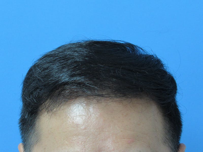 Male Hair Transplant Before & After Gallery - Patient 232158 - Image 4