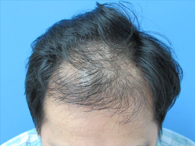 Male Hair Transplant Before & After Gallery - Patient 232158 - Image 5
