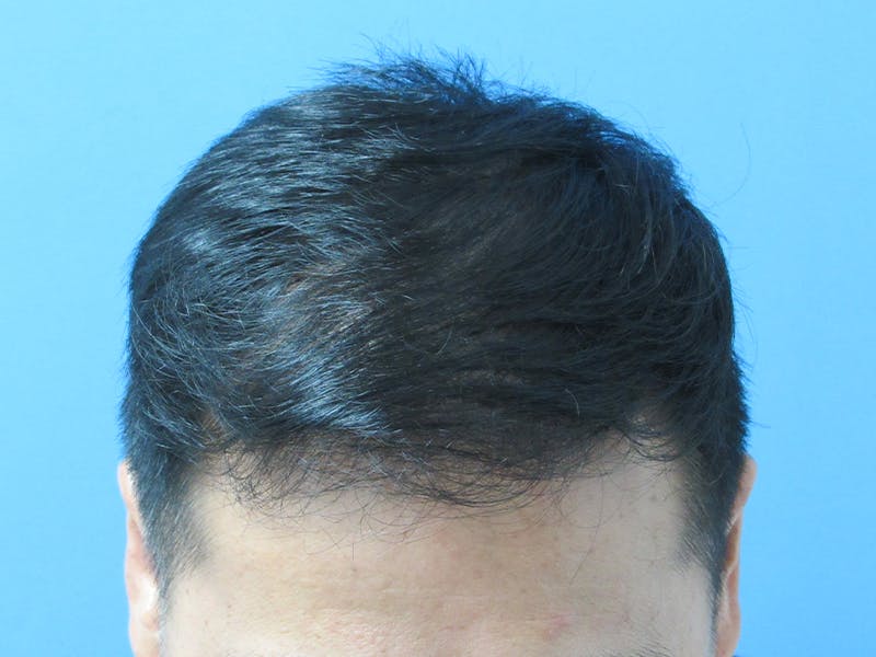 Male Hair Transplant Before & After Gallery - Patient 232158 - Image 6