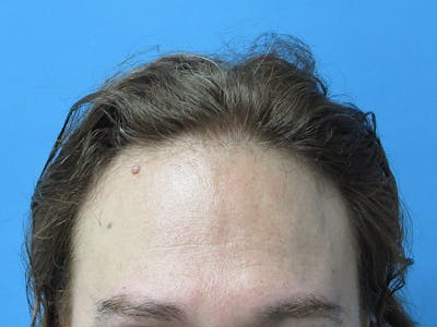 Male Hair Transplant Before & After Gallery - Patient 134715 - Image 1