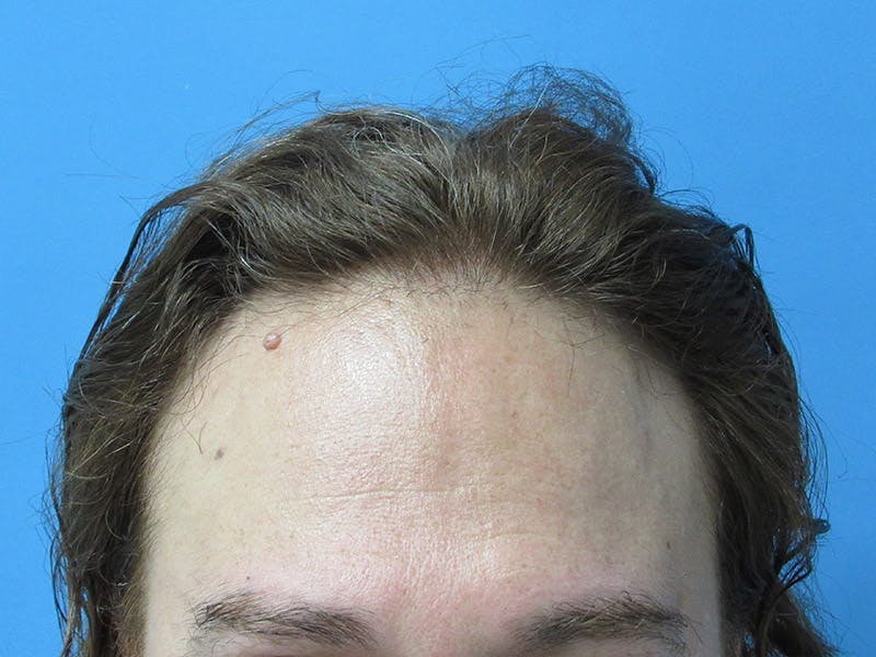 Male Hair Transplant Before & After Gallery - Patient 134715 - Image 1