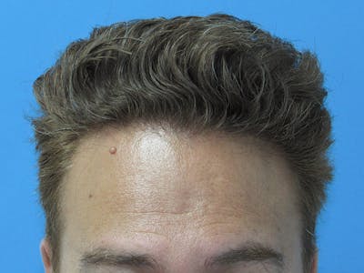 Male Hair Transplant Before & After Gallery - Patient 134715 - Image 2