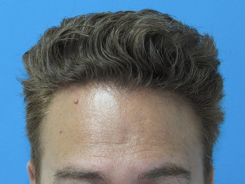 Male Hair Transplant Before & After Gallery - Patient 134715 - Image 2