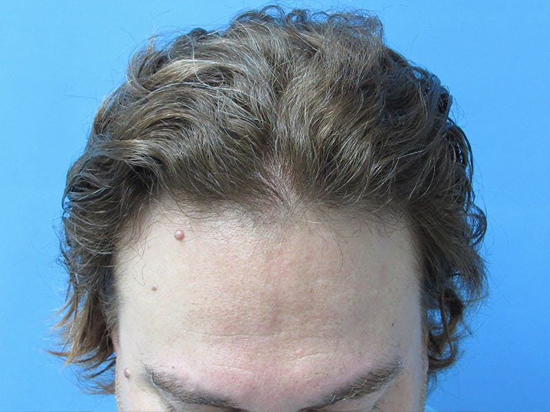 Male Hair Transplant Before & After Gallery - Patient 134715 - Image 3