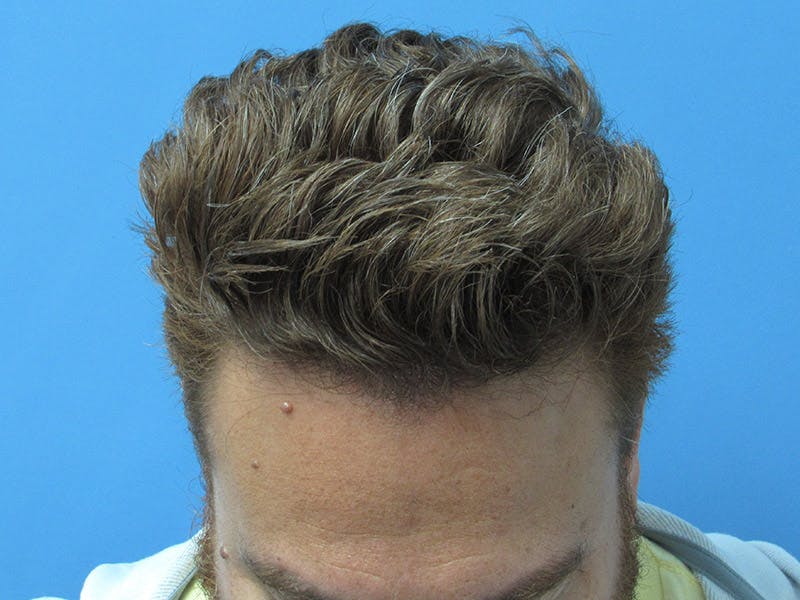 Male Hair Transplant Before & After Gallery - Patient 134715 - Image 4